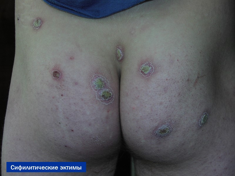 Сифилитические эктимы